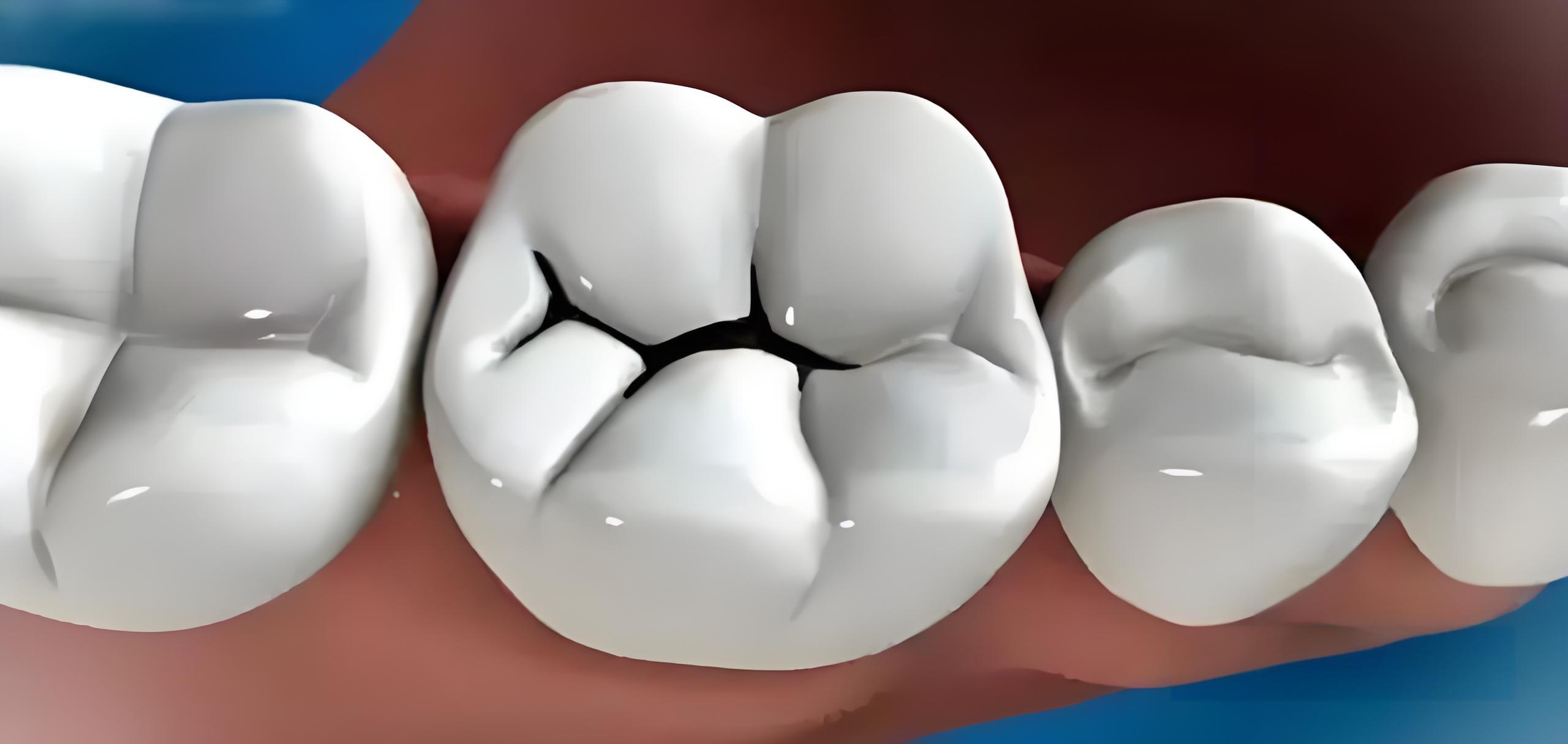 精美圖片展示牙醫補牙全過程